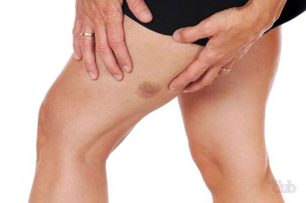 ha egy ér felszakad