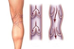 a vér kiáramlása a varikózus vénákban a betegség kialakulásának különböző szakaszaiban